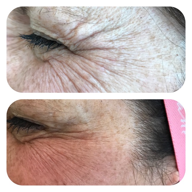 Crows feet treatment with botox-sm